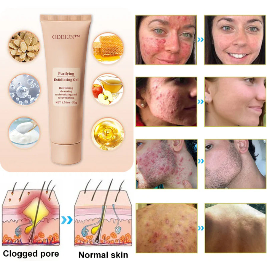 ODEIUN™ Purifying Exfoliating Gel for Acanthosis Nigricans, Exfoliation, Dark Spots, Skin Tags, and Eczema