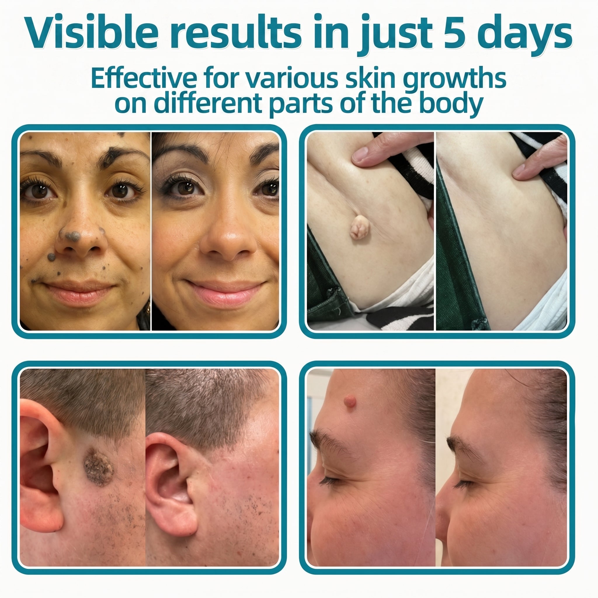 ✅🇺🇸𝐇𝐞𝒂𝒍𝗿𝗶𝙯𝙚®2-in-1 Microneedle & Hydrocolloid Patch🎀| Removes Raised Moles, Acne, Flat Warts & Skin Tags | Helps Improve Wrinkles, Scars & Blemishes | Invisible Patches for Face & Body
