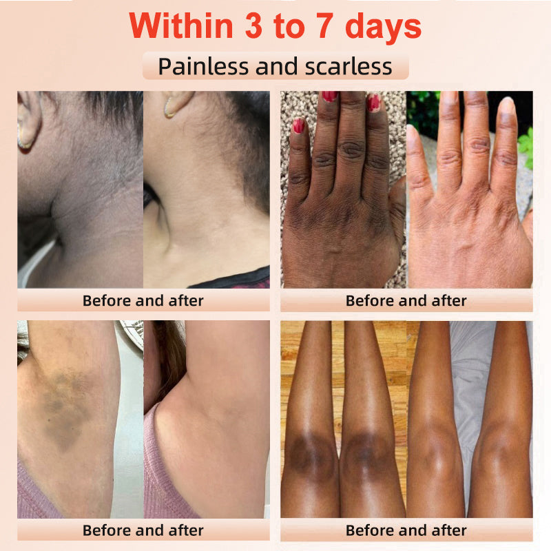 ODEIUN™ Purifying Exfoliating Gel for Acanthosis Nigricans, Exfoliation, Dark Spots, Skin Tags, and Eczema