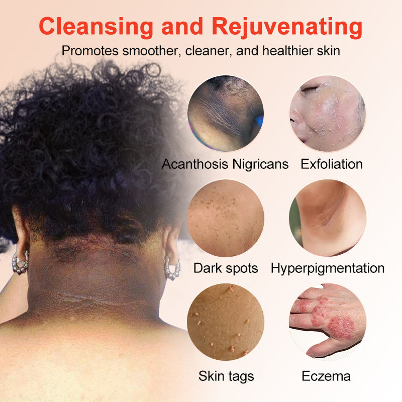 ODEIUN™ Purifying Exfoliating Gel for Acanthosis Nigricans, Exfoliation, Dark Spots, Skin Tags, and Eczema